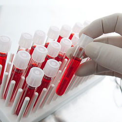 Аналіз крові на глікозильований гемоглобін - що це таке?